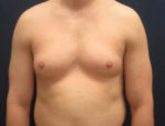 Cosmetic Procedure for Men Results New Jersey