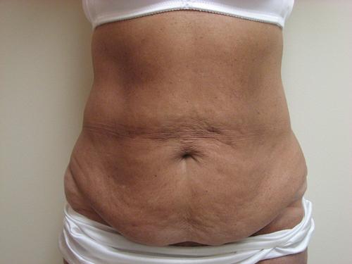 Abdominoplasty/Tummy Tuck