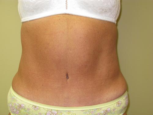 Tummy Tuck Before & After Results