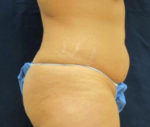 Abdominoplasty/Tummy Tuck