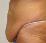 Abdominoplasty/Tummy Tuck