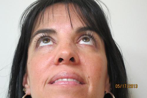 Blepharoplasty (Eyelids)