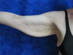 Brachioplasty (arm lift)