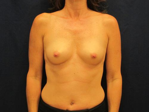 Breast Augmentation Ocean County and Tom's River