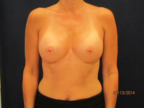 Breast Augmentation Results Ocean County and Tom's River