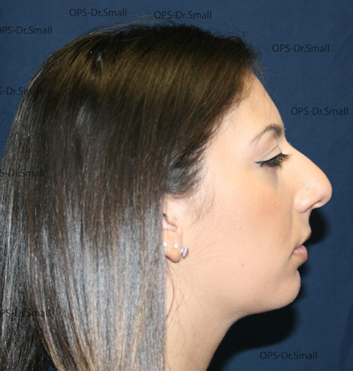 Rhinoplasty (nose job)