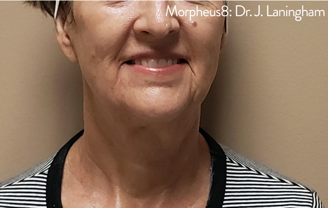 Morpheus8 Before & After Results
