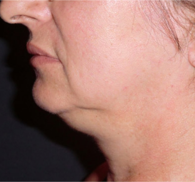 Accutite™ Before & After Results