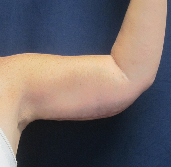 Brachioplasty (arm lift)