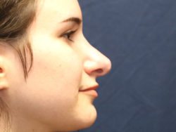 Rhinoplasty (nose job)