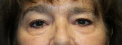 Blepharoplasty (Eyelids)
